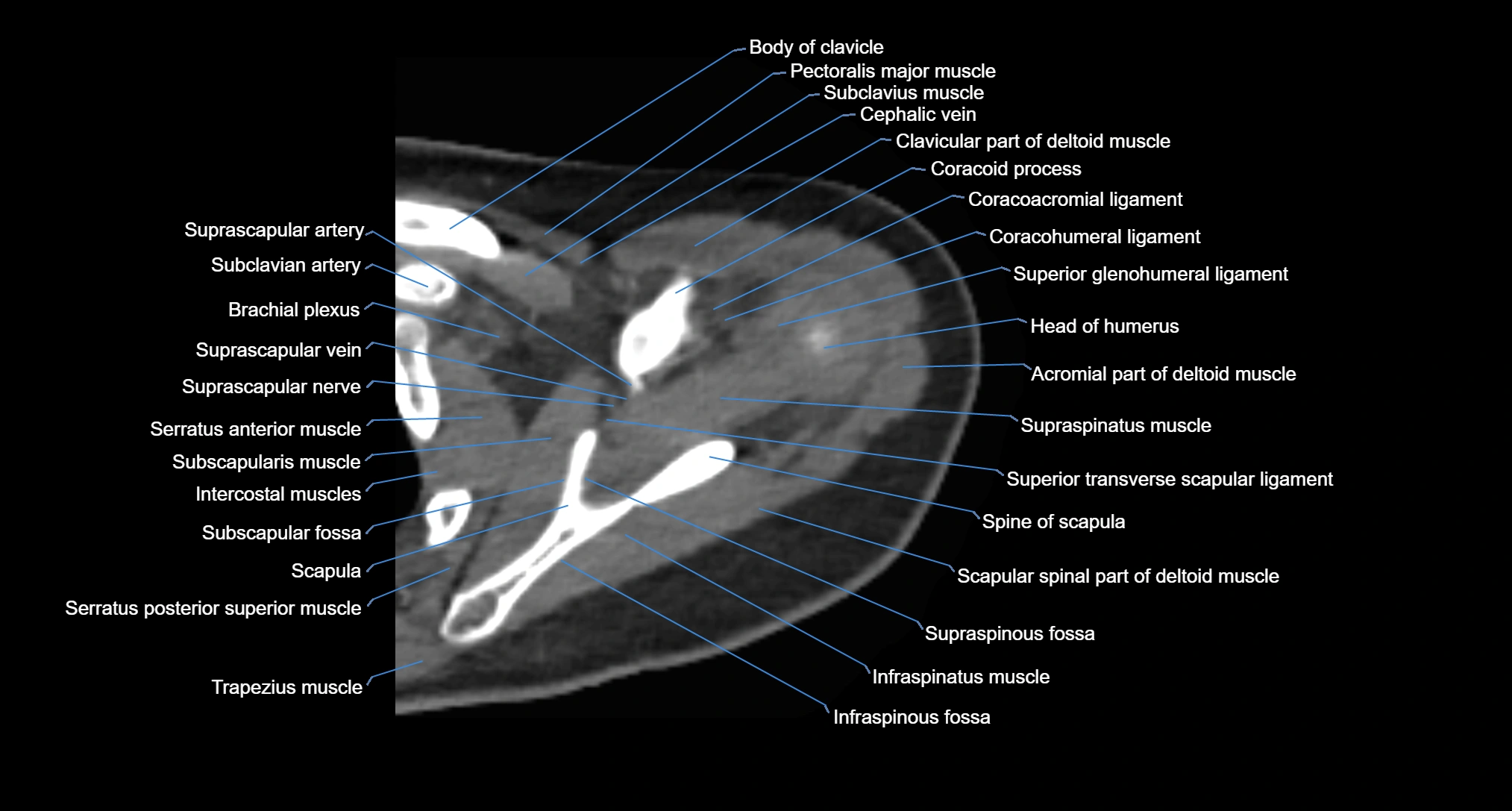 CT Shoulder axial cross sectional anatomy labelled radiology image -00022.webp